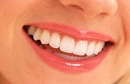 Evde Diş Beyazlatma