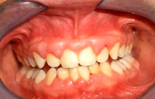 Diş Eti Tedavisi Nasıl Yapılır?