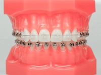 Ortodonti Nedir? ve Ortodonti Görevleri