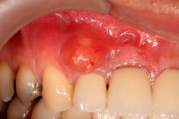 Diş Apsesi Belirtileri ve Tedavisi