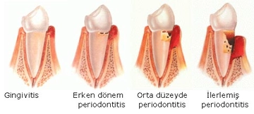 Diş Eti Çekilmesi Tedavisi